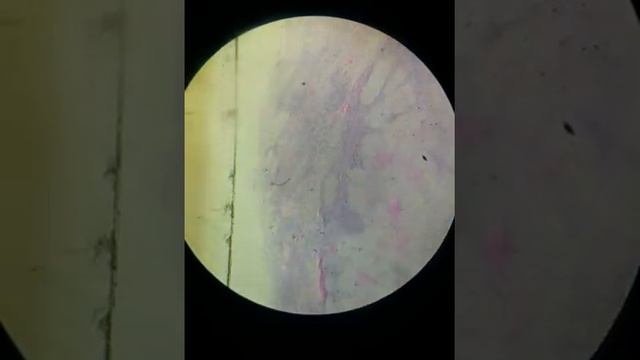 21 Early TB of lymph node смотреть онлайн