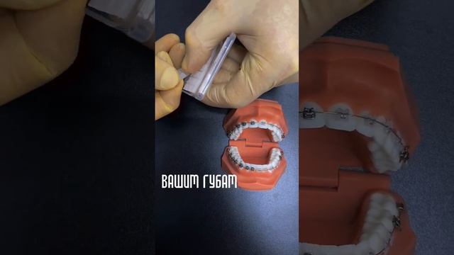 Если брекеты царапаются и ведут себя кровожадно,используйте воск для комфортного прохождения лечени