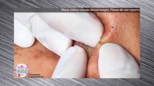 ОГРОМНЫЕ СОЧНЫЕ ЧЕРНЫЕ ТОЧКИ НА ЛИЦЕ | ЧИСТКА БОЛЬШИХ УГРЕЙ