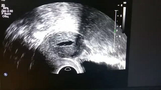 серозометра и синехии полости матки.  Serosometer And Synechiae Of The Uterine Cavity