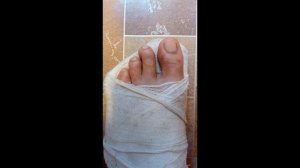 Перелом плюсневых костей стопы, последствия спустя год