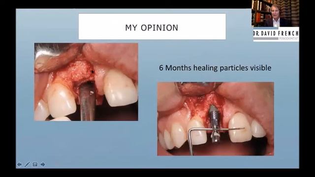 Peri-Implantitis with Dr. David French (PART 2) Risk Indicators смотреть онлайн