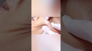 Акне. Черные точки. Вросшие волосы и прыщи. Ушная пробка и сера!