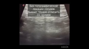УЗИ диагностика косой паховой грыжи. Профессор Гажонова В.Е.
