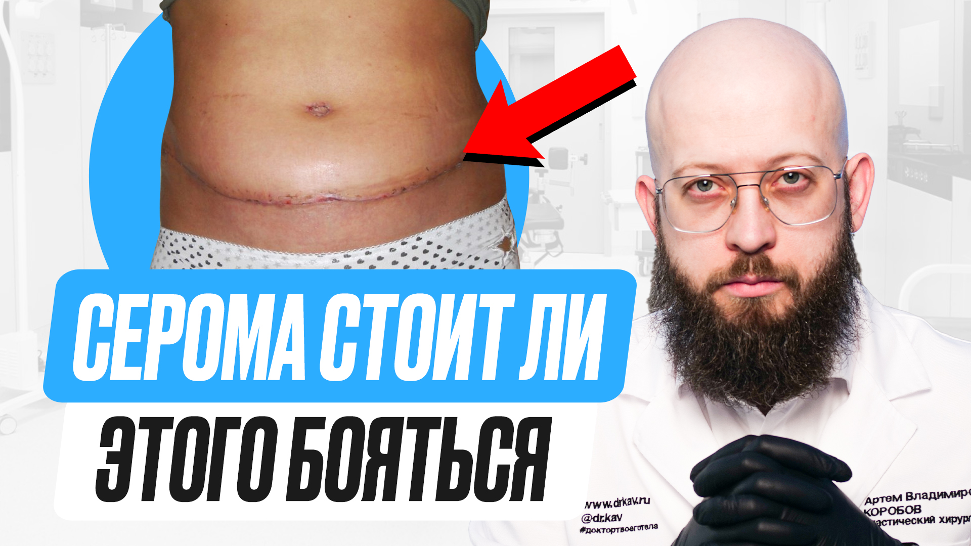 Что такое серома? Почему возникает серома? Профилактика серомы после пластической операции смотреть онлайн