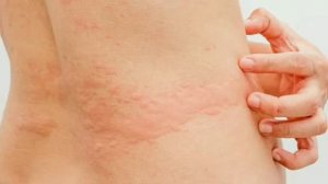 Крапивница ,причины и симптомы !   Какие  виды крапивницы бывают!