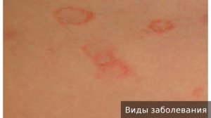 Паховая эпидермофития. Как лечить паховую эпидермофитию.