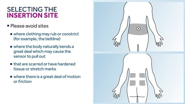 Medtronic Guardian Connect - как установить сенсор смотреть онлайн
