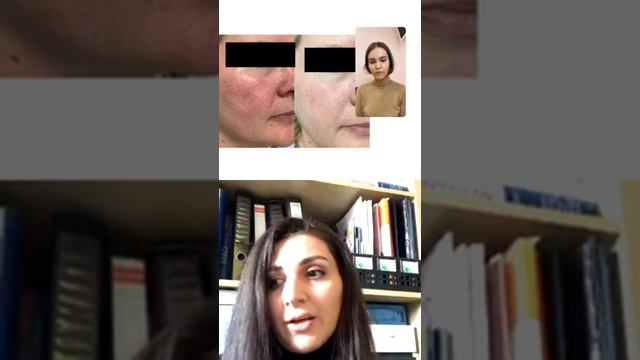 О РОЗАЦЕА. ОТВЕТЫ НА ЧАСТЫЕ ВОПРОСЫ О РОЗАЦИИ И КУПЕРОЗЕ С ВРАЧОМ ЦИДК АСАНОВИЧ Л.В. смотреть онлайн