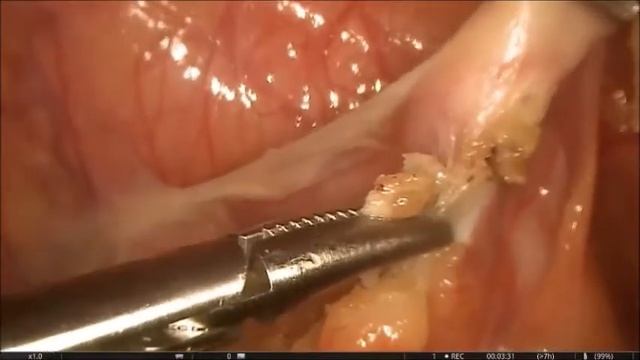 Лапароскопия при остром флегманозном аппендиците смотреть онлайн