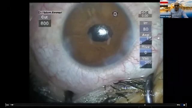 Cataract in difficult situations How to be ready смотреть онлайн