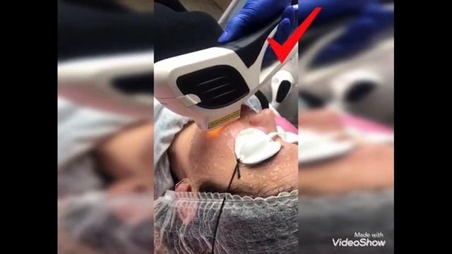 Фотоомоложение смотреть онлайн