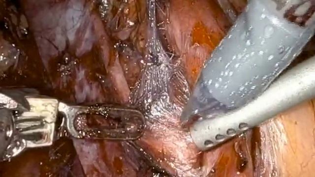 Outpatient Robotic Assisted Retroperitoneal Lymph Node Dissection for Testicular Cancer смотреть онлайн