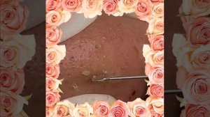 чистка лица. большие жирные угри