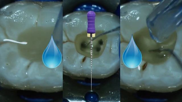 ProTaper Next™ Technique With Dr. Scianamblo | Dentsply Sirona