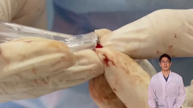 Послойный синус-лифтинг смотреть онлайн