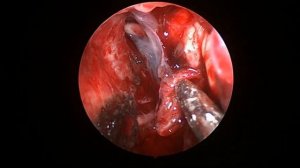 Невринома слухового нерва 38 мм