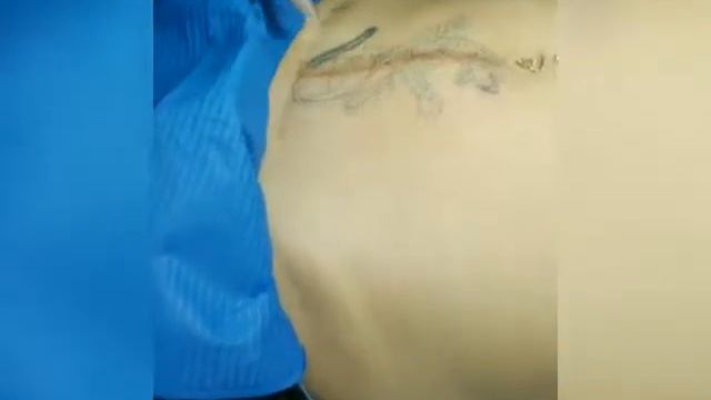 Лазерное удаление татуировки смотреть онлайн