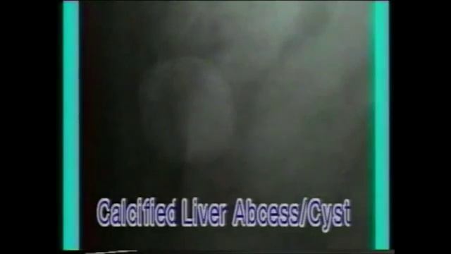 6.2.5. Calcified Lymph Node - KUB X-rays - Dr. Vaidya смотреть онлайн