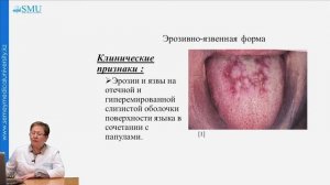 Красный плоский лишай (КПЛ)