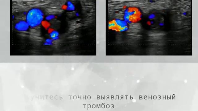 Ультразвуковая диагностика при заболеваниях вен. Что нужно знать флебологу?