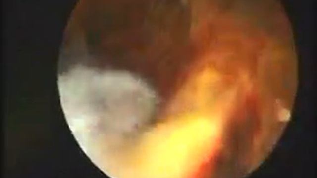 Hysteroscopic aspect of trophoblastic retention смотреть онлайн