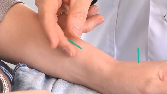 Иглоукалывание иглотерапия в Дельтаклиник смотреть онлайн