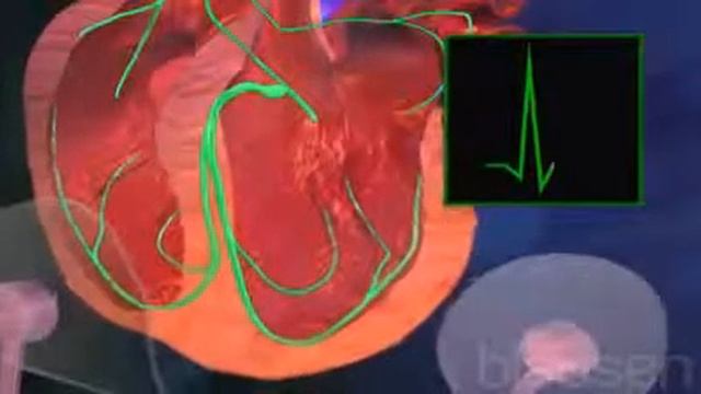 Сердечная аритмия смотреть онлайн