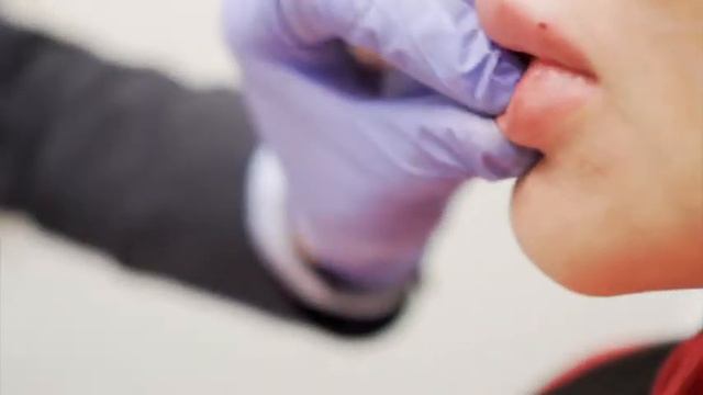 Cherry Lips - Lip Fillers With Juvederm