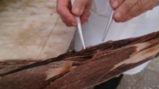 Плечевое сплетение. Plexus brachialis смотреть онлайн