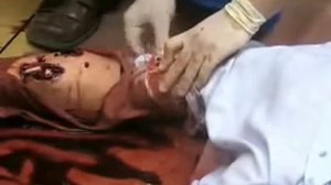 остановка кровотечения наложением жгута закрутки