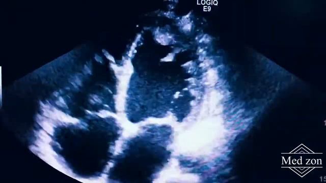 ТРОМБ В ЛЕВОМ ЖЕЛУДОЧКЕ смотреть онлайн