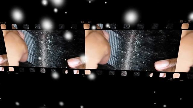 ★ Как избавиться от перхоти. Как выбрать шампуть от перхоти. Лечение перхоти дома смотреть онлайн