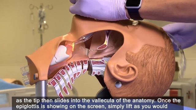 How To Intubate With McGrath™ MAC Video Laryngoscopy Using The Mac-3