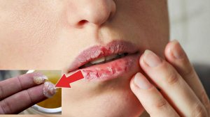 Обветренные губы заживают мгновенно после этого! Народные способы лечения обветренных губ и герпеса
