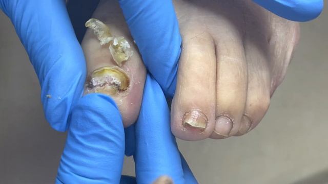 Pedicure Tutorial：Thoroughly Trim Nail Fungus【Pedicure Master Lin Jun】