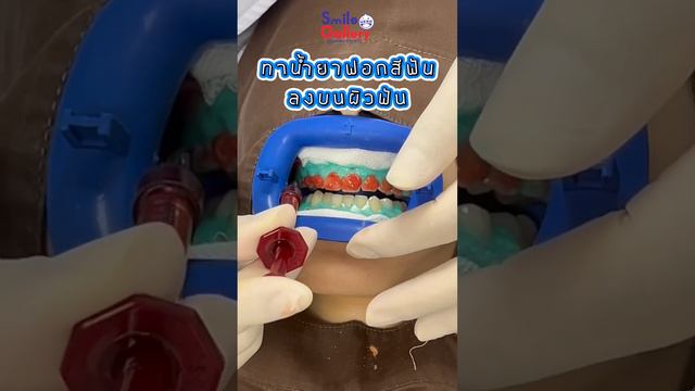 ฟันขาวภายใน 45 นาที🦷✨ด้วยน้ำยานำเข้า🇺🇸| Smile Gallery Dental смотреть онлайн