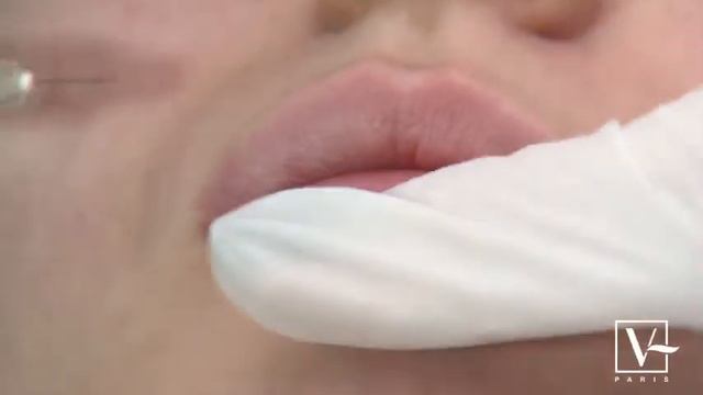 BUZE SI NAS - Injectare STYLAGE Special Lips + STYLAGE M Cu MEPIVACAINE
