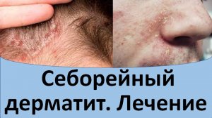 Лечение себорейного дерматита