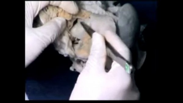 25 Rastelli Operation for DORV