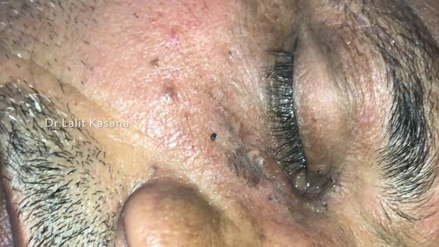 OLD EYE BLACKHEADS REMOVAL BY DR.LALIT KASANA смотреть онлайн