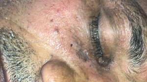 OLD EYE BLACKHEADS REMOVAL BY DR.LALIT KASANA