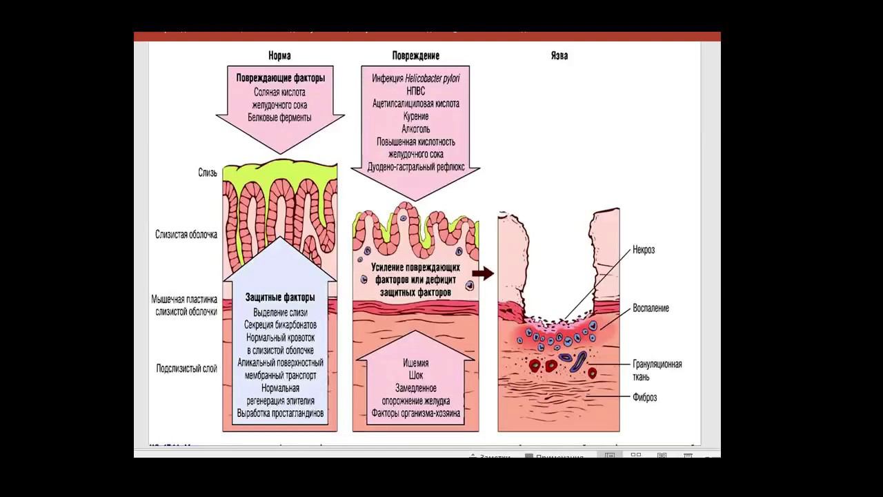Патофизиология пищеварения - язвенная болезнь
