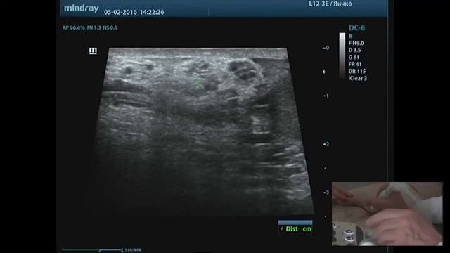 Ультразвуковое исследование мошонки. Паховая грыжа смотреть онлайн