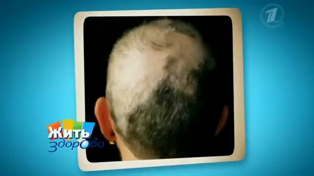 Что делает женщину лысой? От чего выпадают волосы