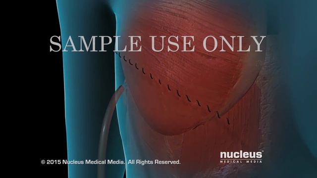 Breast Cancer | Tumor Removal Surgery | Nucleus Health смотреть онлайн