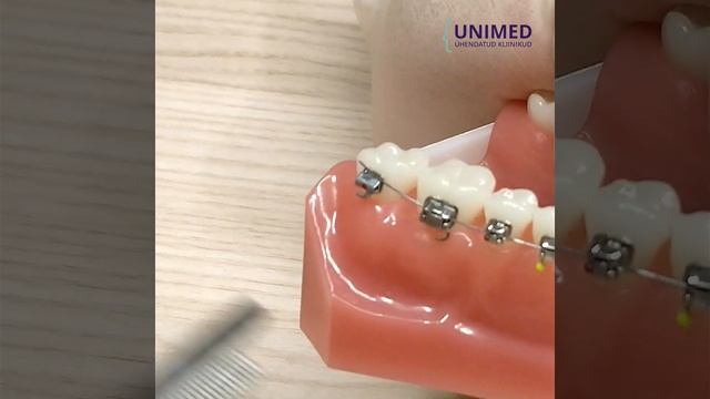 Что делать, когда конец проволоки (дуги) выскочил из брекета и колит? смотреть онлайн