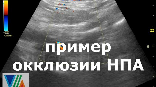 Стеноз правой НПА. Окклюзия левой НПА. смотреть онлайн