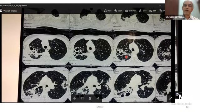 Clinical Updates and Innovation in Tuberculosis for 2023 смотреть онлайн