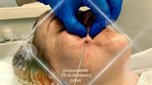 Сепарация морщин и рубцов смотреть онлайн